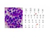 Figura 2. Imagen de una muestra de Leucemia Mielode Crónica vista al microscopio (izda.) y su cariotipo con el cromosoma Filadelfia (dcha. Crs.22). 